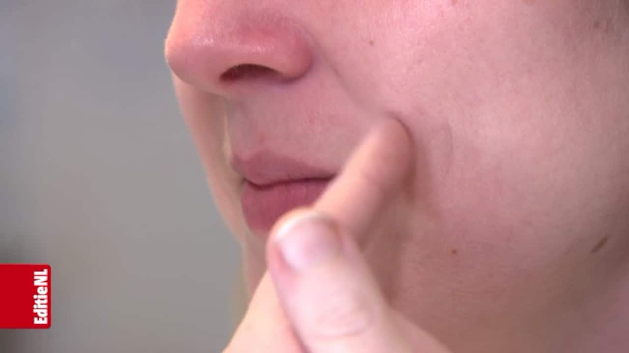 Rimpels van de suiker?