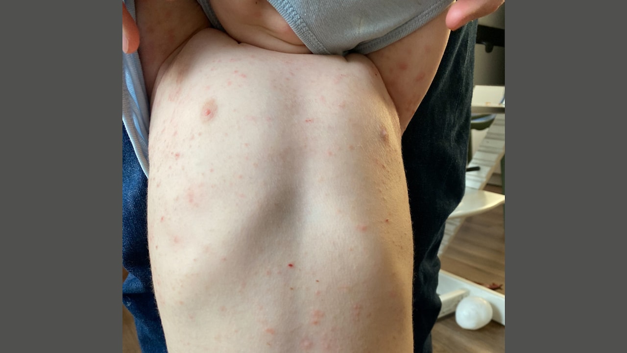 Lela streed maanden tegen schurft bij haar kindjes, artsen willen hardere aanpak