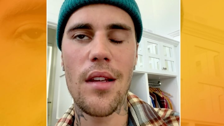 Dít moet Justin Bieber doen om van zijn gezichtsverlamming af te komen