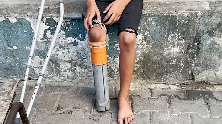 Van rioolpijp naar echte prothese: Rateb (10) uit Gaza krijgt weer hoop