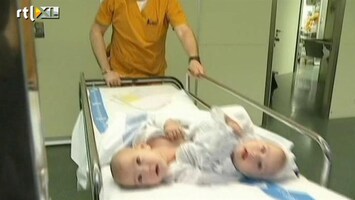 RTL Nieuws Spaanse Siamese tweeling gescheiden