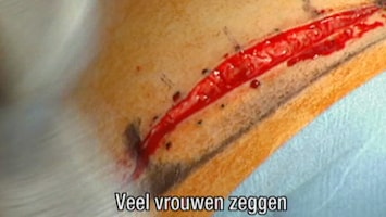 Het Verhaal Achter Plastische Chirurgie Afl. 4