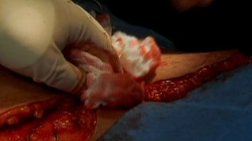 Het Verhaal Achter Plastische Chirurgie Afl. 19