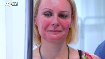 Dit Is Mijn Lijf Rosacea