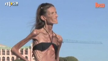 Editie NL Drama: vrouw weegt 24 kg door anorexia