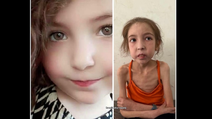 12-jarige Rahaf weegt 12 kilo: 'Het liefst neem ik haar op in het ziekenhuis'
