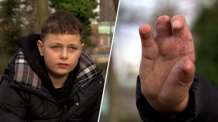 Zwaar vuurwerk explodeert in Sydneys hand, nu waarschuwt hij met deze campagne