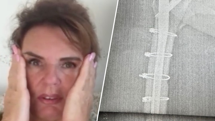 Elisa Rutten uit Daar Gaan Ze Weer in lappenmand na ongeval: 'Hechtingen tot mijn knie' 