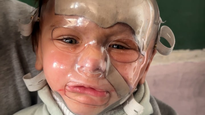 Zorg voor peuter in Gaza met brandwonden dreigt te verdwijnen