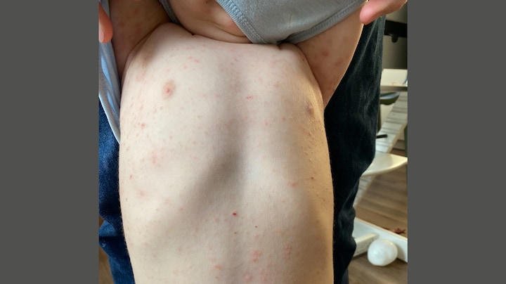 'Jeuk, heel veel jeuk': zoontje Lisanne had maandenlang schurft