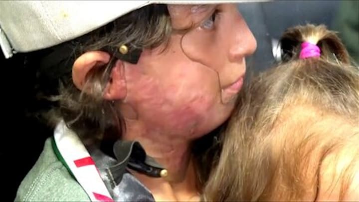 Gewonde en verminkte kinderen uit Gaza in VS voor behandeling